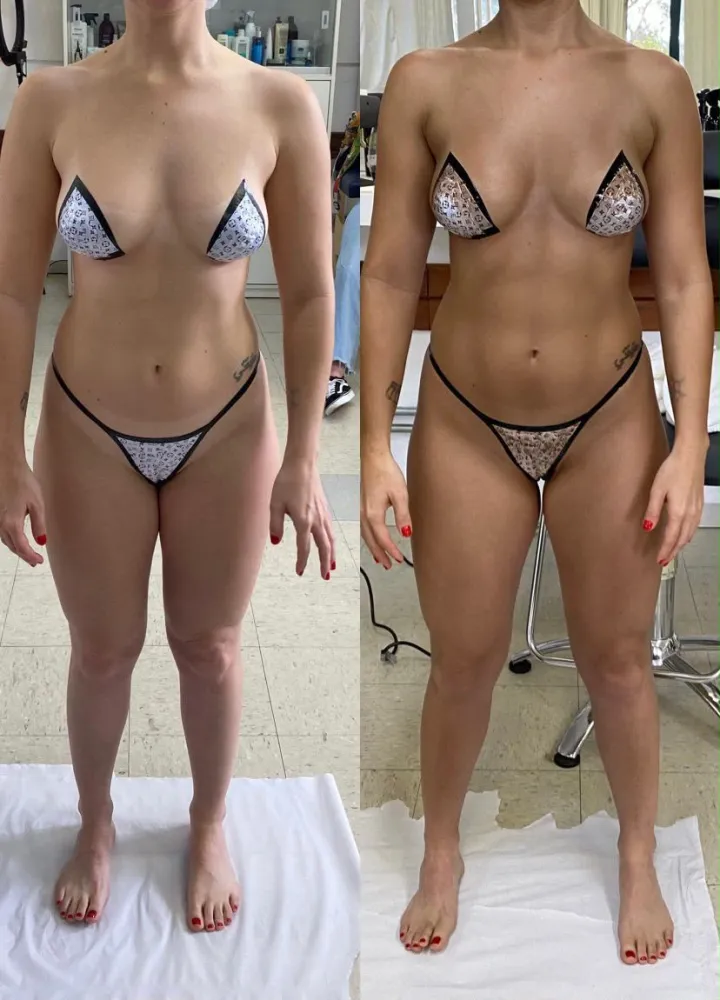 Antes e depois do bronzeamento a jato da mesma cliente, de frente, com a marcação do biquíni.